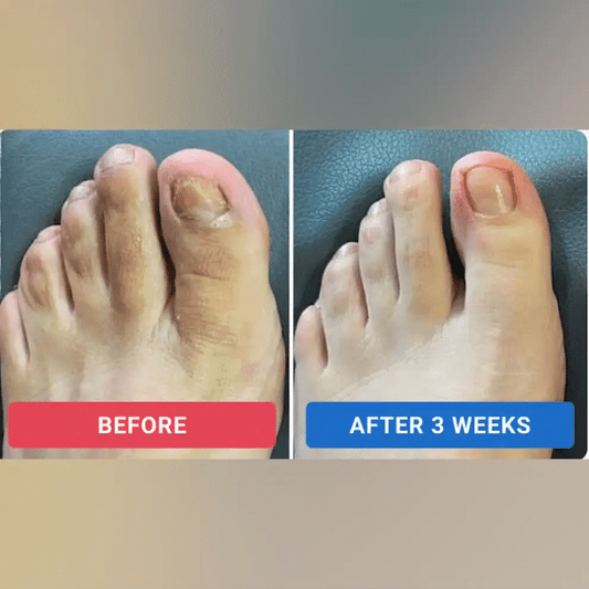 FungalFix™ Nail Renewal Patches